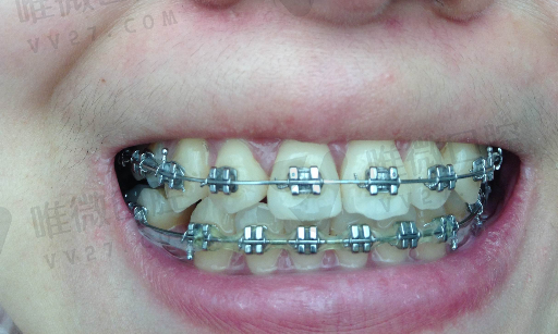 牙弓可以矫正吗（正畸可以把牙弓变小吗）(图1)